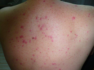 Kolejne przypadki małpiej ospy w Europie. Ogłoszono alert sanitarny
