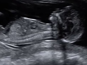 Czy aborcja eugeniczna zostanie zdelegalizowana? Nowy projekt obywatelski z poparciem Episkopatu w Sejmie
