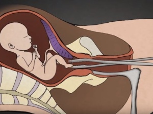 Kłamstwo zdemaskowane! W Anglii i Walii dokonano 13 tysięcy aborcji przez rozerwanie dziecka