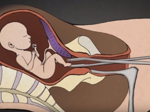 Gubernator Virginii chce prawa do dobijania dzieci po nieudanej aborcji