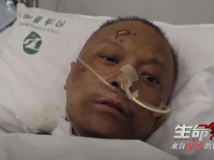 Szokujący skutek Covid-19. Dwaj lekarze z Wuhan bo wybudzeniu ze śpiączki... mają inny kolor skóry!