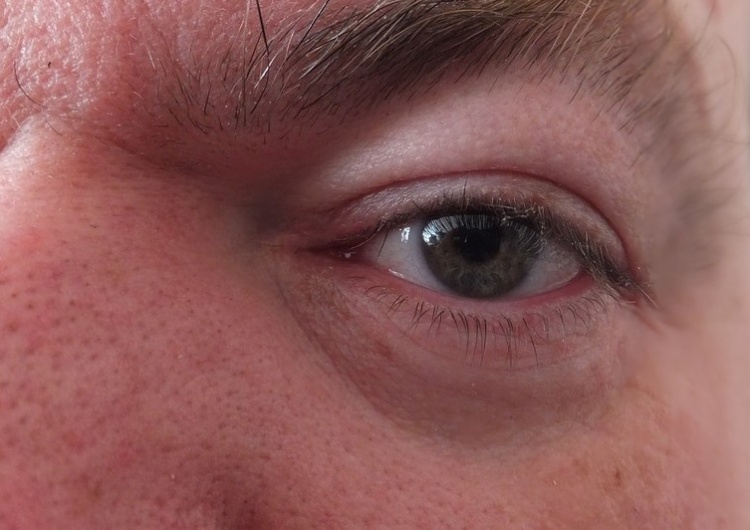 oko Przewlekłe zapalenie powiek - to może być nużyca