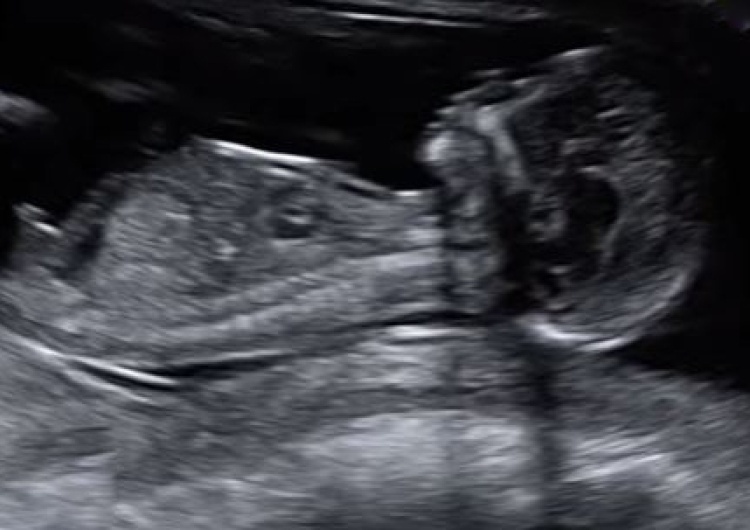  Czy aborcja eugeniczna zostanie zdelegalizowana? Nowy projekt obywatelski z poparciem Episkopatu w Sejmie