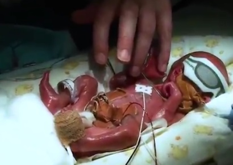 zrzut ekranu Niesamowite video: mały Toby urodził się w 24 tygodniu ciąży