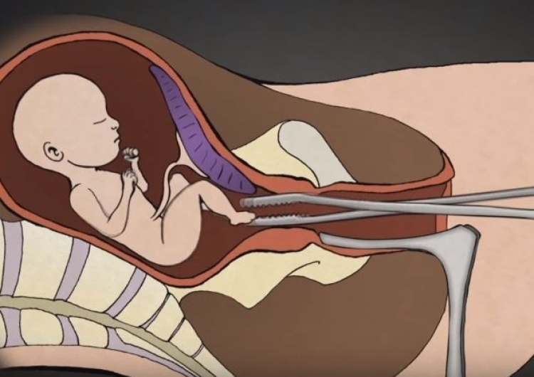 Nauczycielka obniżyła uczniowi ocenę, bo jako przykład łamania praw dziecka wymienił... aborcję
