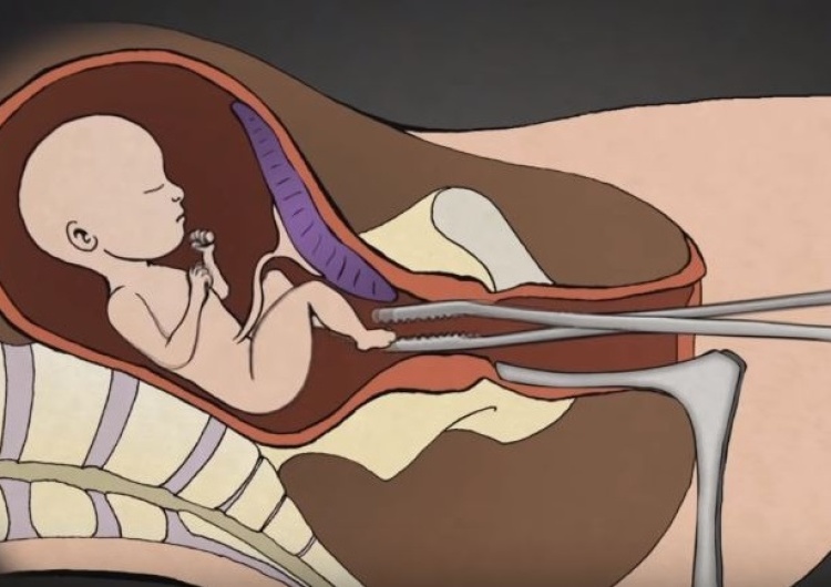  Kłamstwo zdemaskowane! W Anglii i Walii dokonano 13 tysięcy aborcji przez rozerwanie dziecka