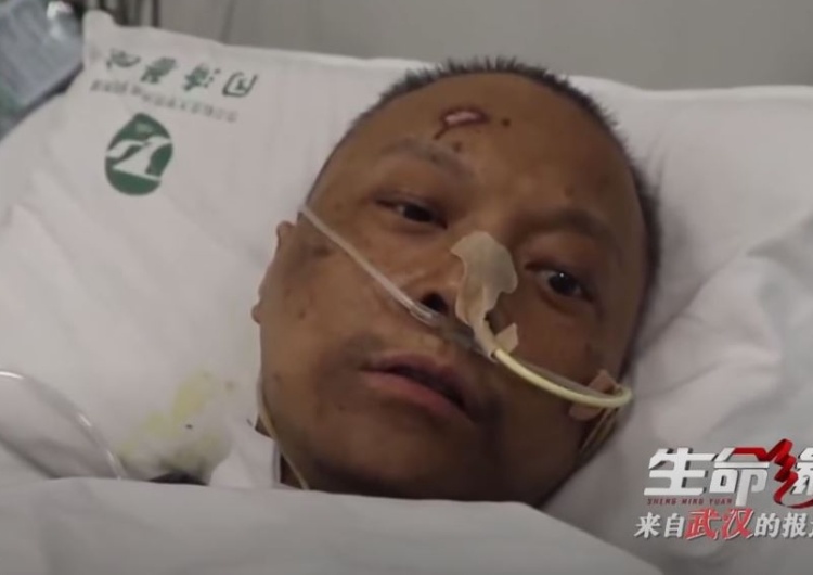 Szokujący skutek Covid-19. Dwaj lekarze z Wuhan bo wybudzeniu ze śpiączki... mają inny kolor skóry!