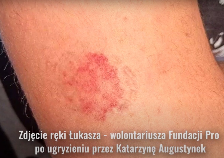Ręka wolontariusza Fundacji Pro - Prawo do życia, jak twierdzi Fundacja, ugryziona przez