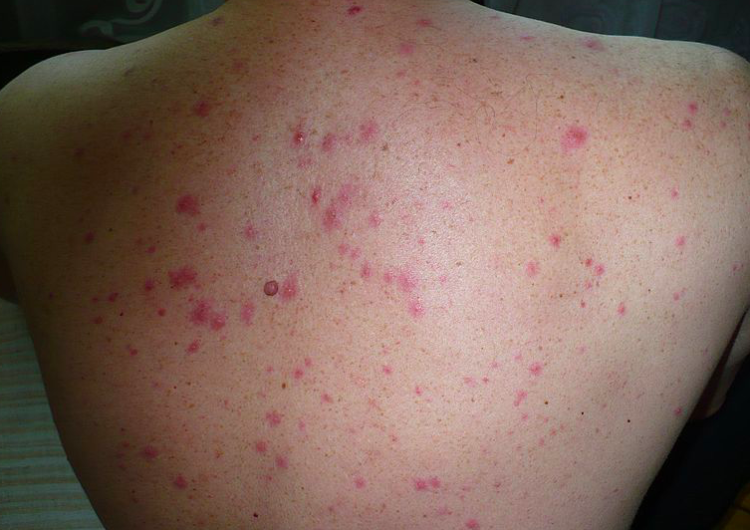 Kolejne przypadki małpiej ospy w Europie. Ogłoszono alert sanitarny